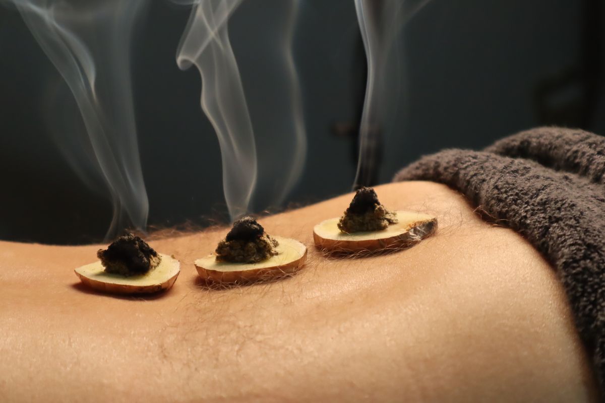 Burning moxa cones on ginger slices during a moxibustion therapy session