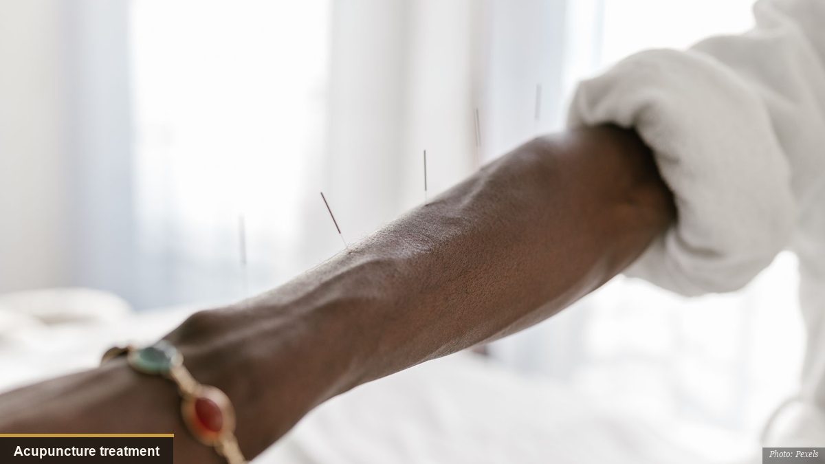 Fine acupuncture needles arranged for a traditional East Asian acupuncture treatment